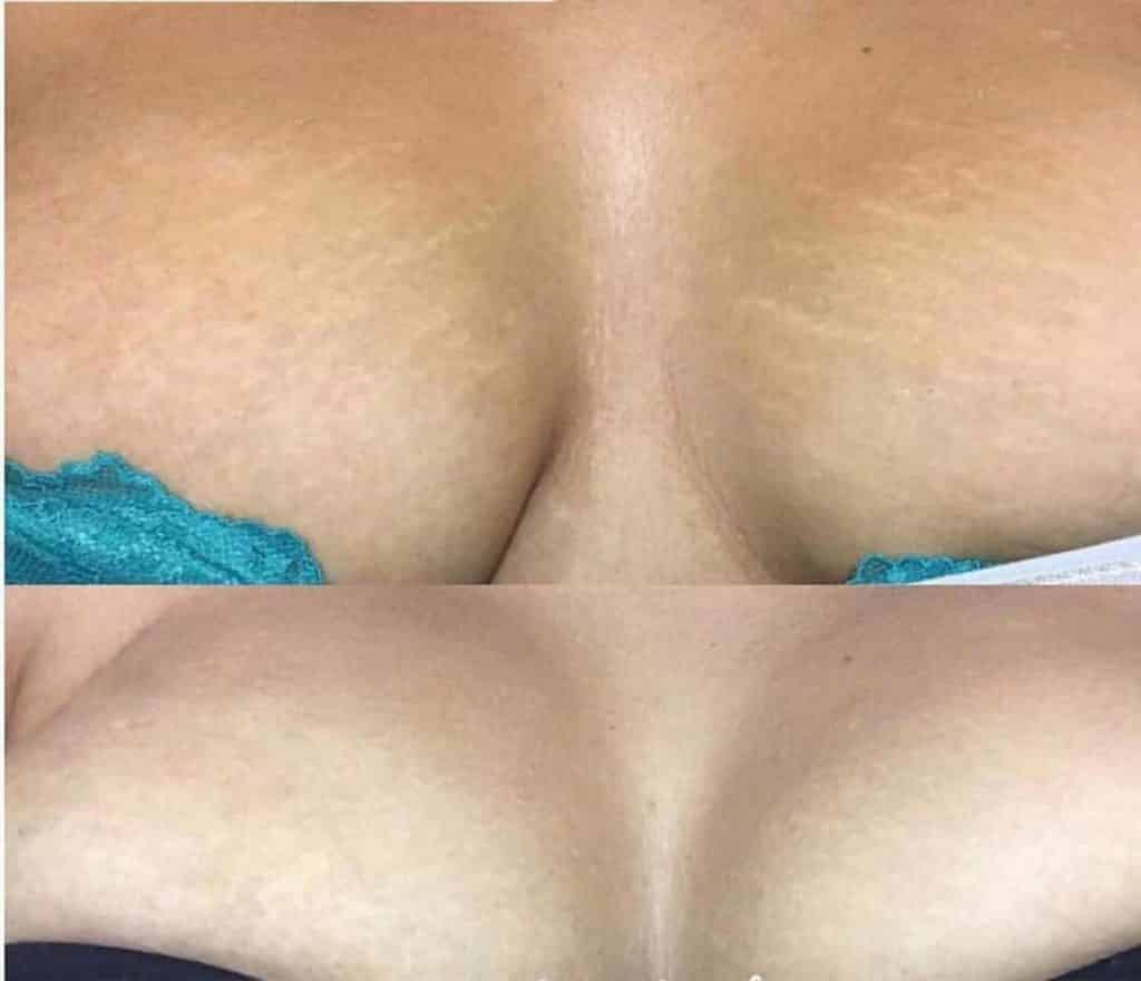Remédio caseiro natural para estrias, celulite e rachaduras na pele Remédio caseiro natural para estrias, celulite e rachaduras na pele